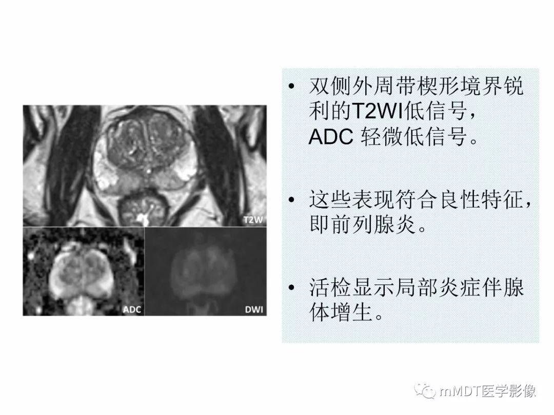 【PPT】前列腺癌：影像报告与数据系统（版本2）