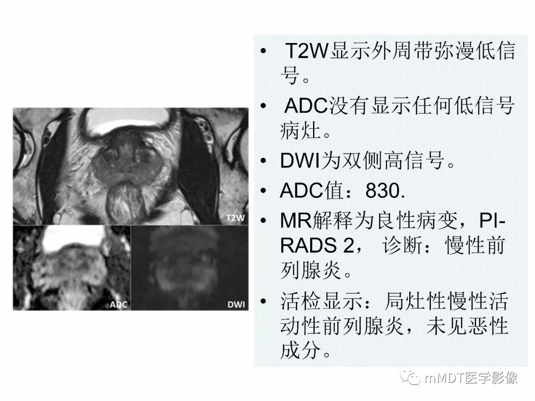 【PPT】前列腺癌：影像报告与数据系统（版本2）