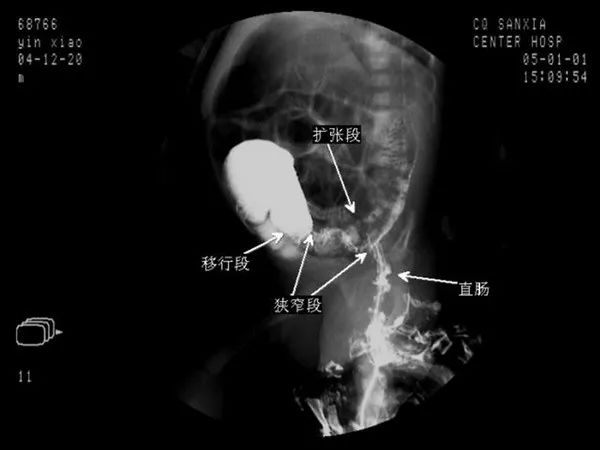 【PPT】先天性巨结肠的影像学诊断