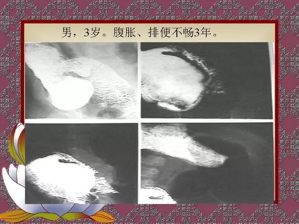 【PPT】先天性巨结肠的影像学诊断