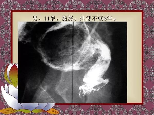 【PPT】先天性巨结肠的影像学诊断