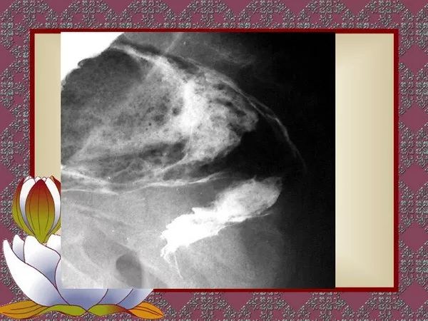 【PPT】先天性巨结肠的影像学诊断