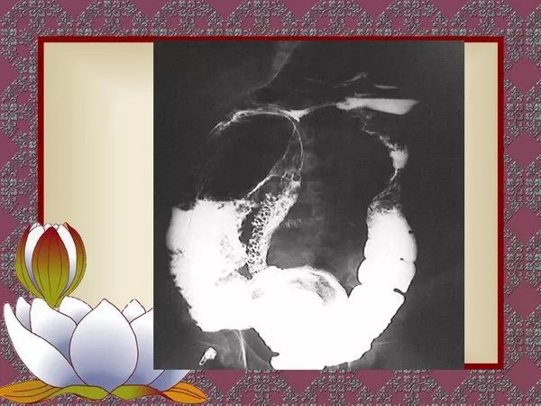 【PPT】先天性巨结肠的影像学诊断