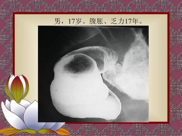 【PPT】先天性巨结肠的影像学诊断