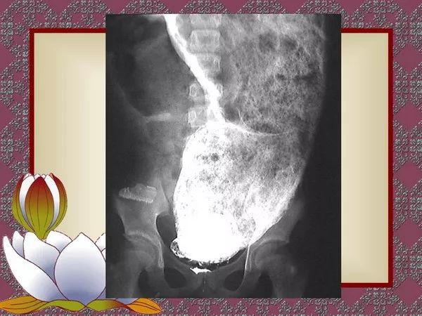 【PPT】先天性巨结肠的影像学诊断