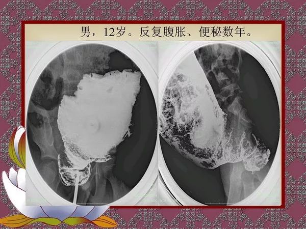 【PPT】先天性巨结肠的影像学诊断