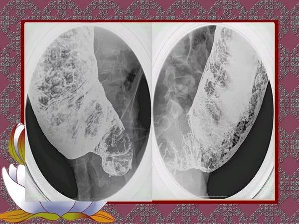 【PPT】先天性巨结肠的影像学诊断