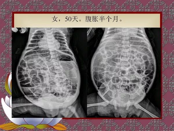 【PPT】先天性巨结肠的影像学诊断