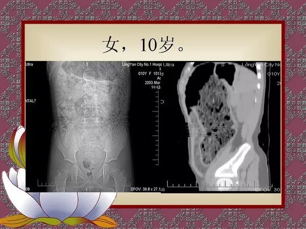 【PPT】先天性巨结肠的影像学诊断