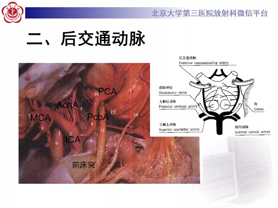 【PPT】脑动脉解剖及供血区分布