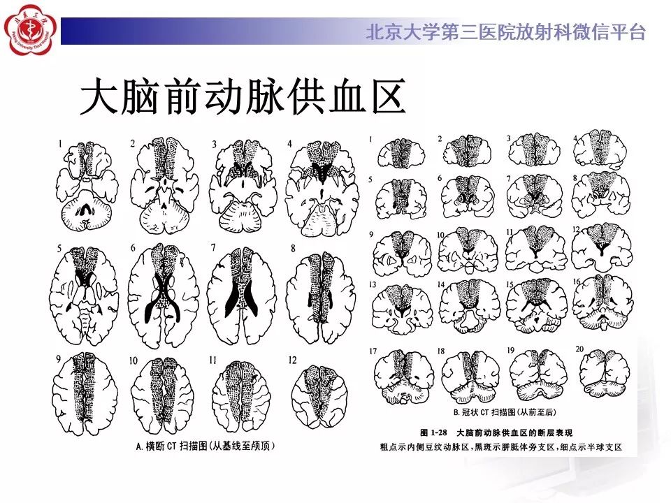 【PPT】脑动脉解剖及供血区分布