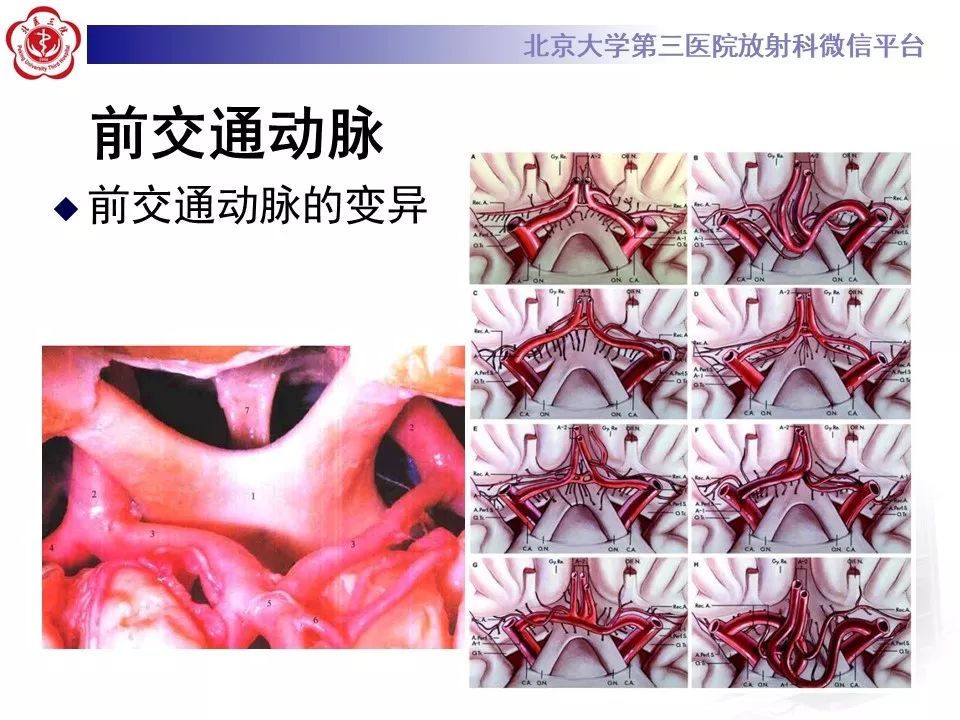 【PPT】脑动脉解剖及供血区分布