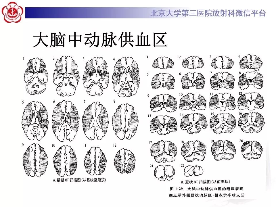 【PPT】脑动脉解剖及供血区分布