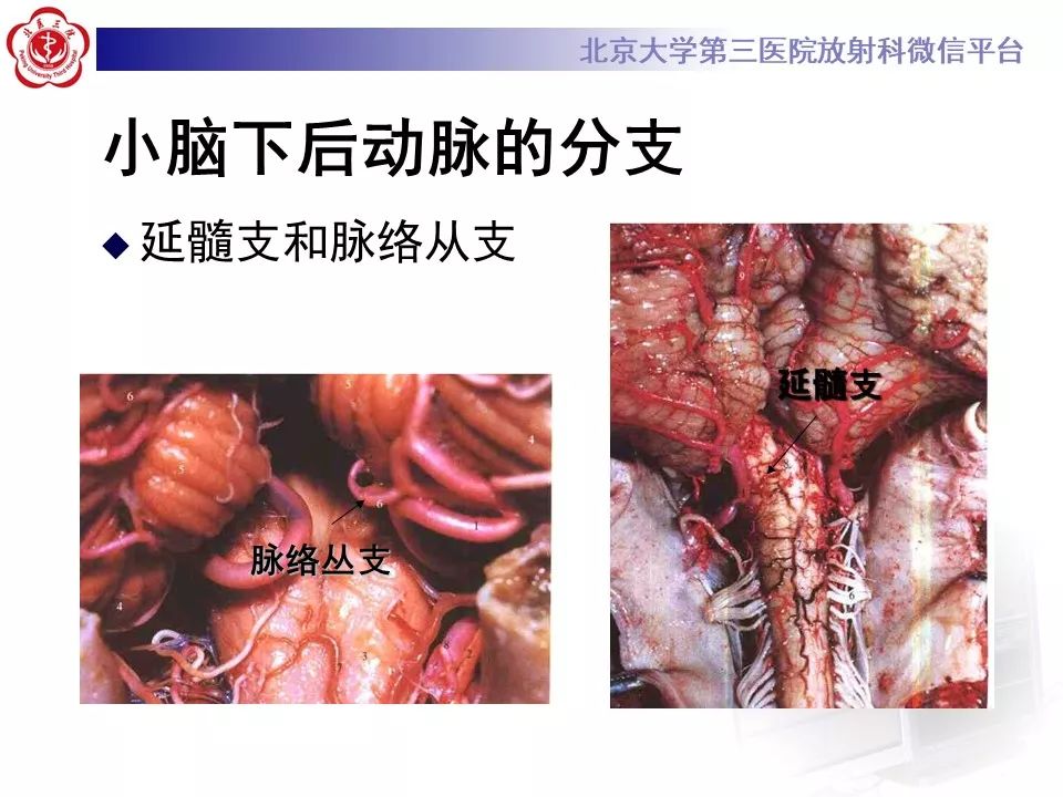 【PPT】脑动脉解剖及供血区分布