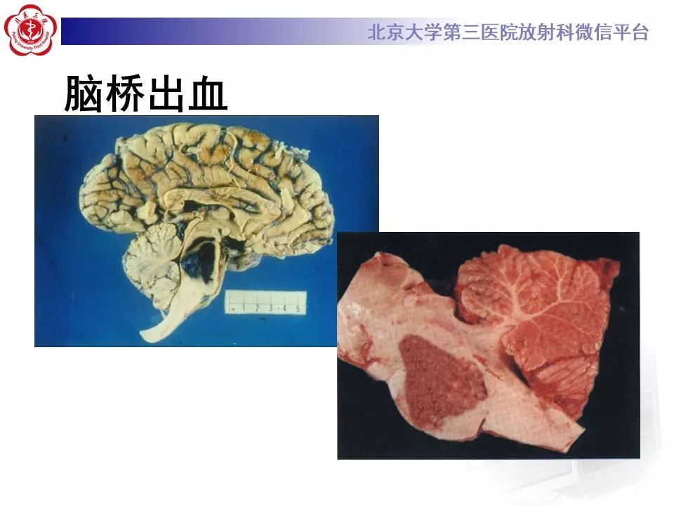 【PPT】脑动脉解剖及供血区分布