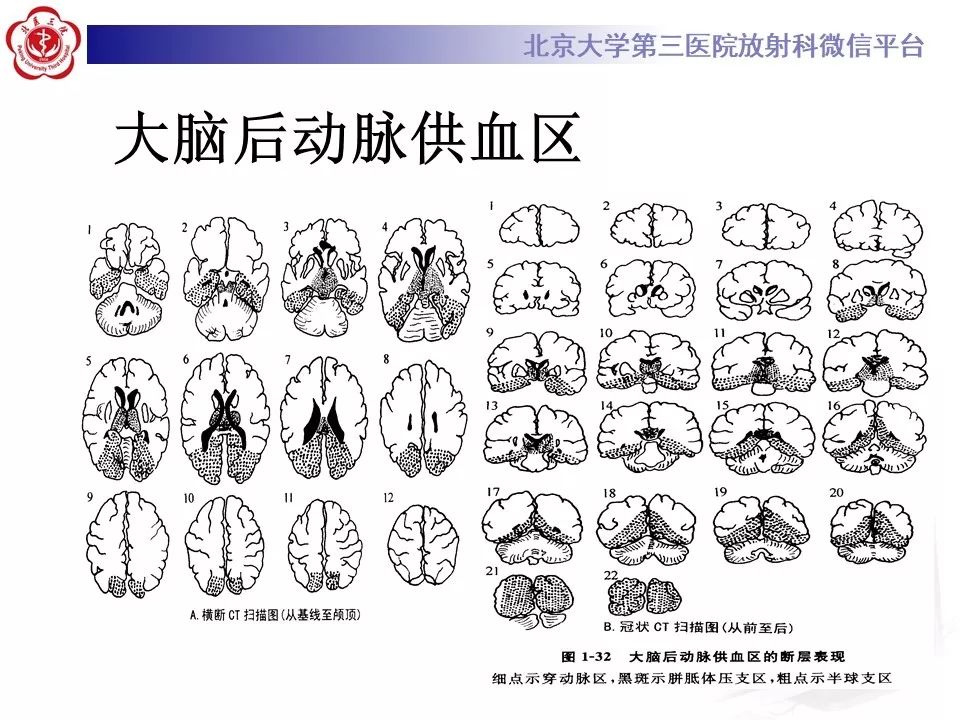 【PPT】脑动脉解剖及供血区分布
