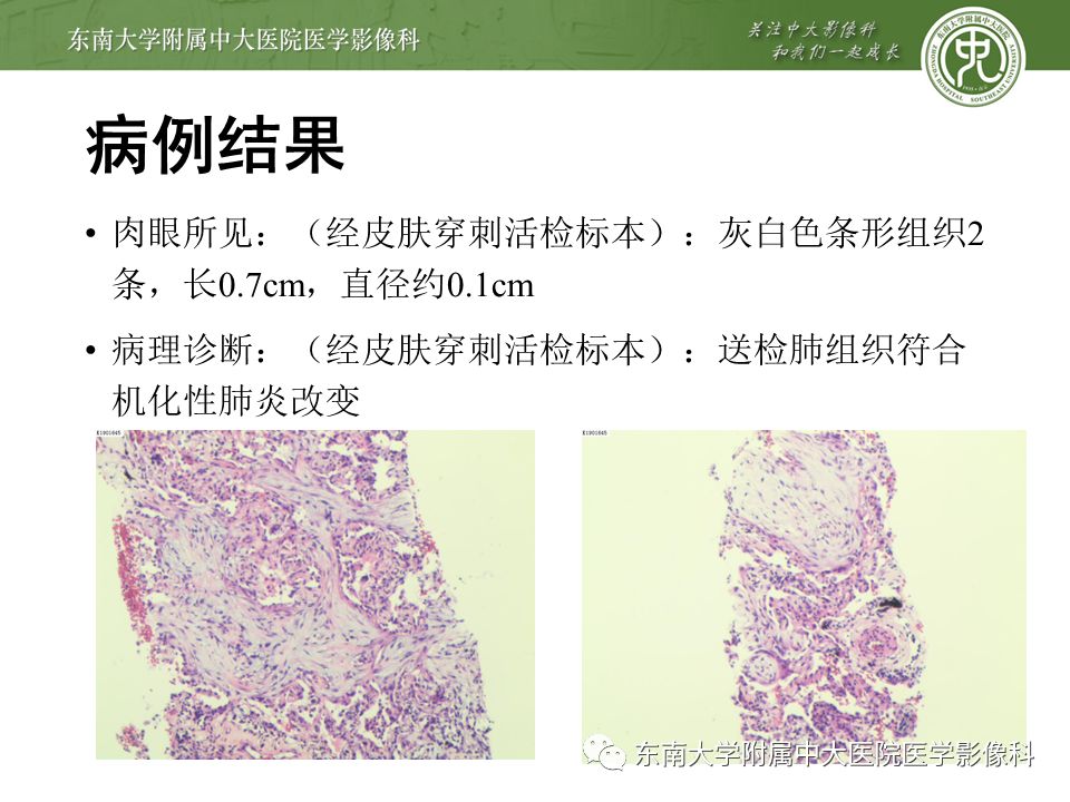 【PPT】局灶性机化性肺炎