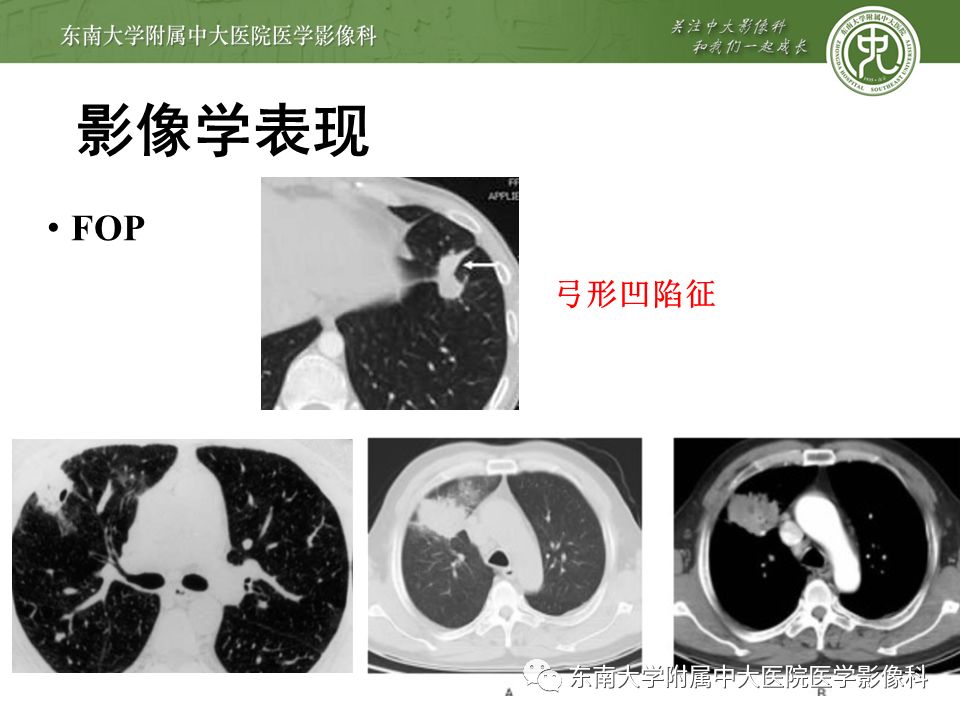 【PPT】局灶性机化性肺炎