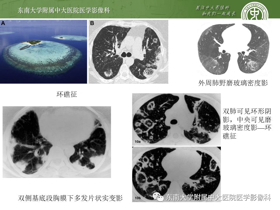 【PPT】局灶性机化性肺炎