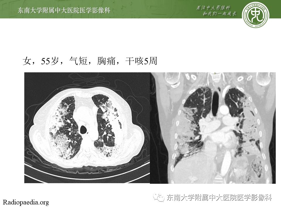 【PPT】局灶性机化性肺炎