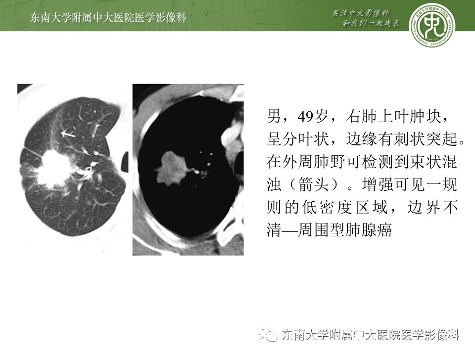 【PPT】局灶性机化性肺炎