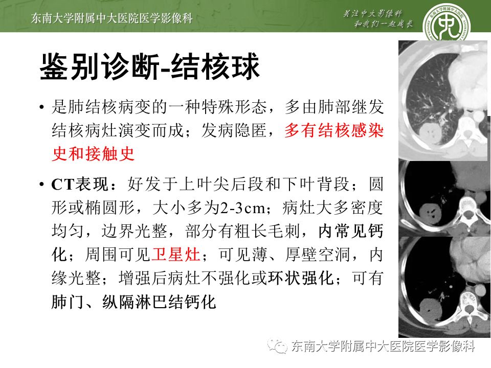 【PPT】局灶性机化性肺炎