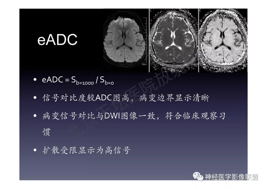 【PPT】颅内DWI高信号的MRI诊断