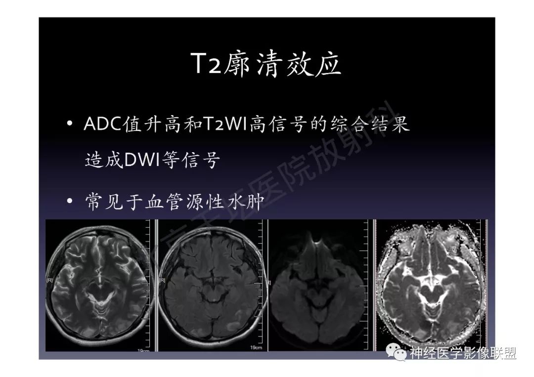 【PPT】颅内DWI高信号的MRI诊断