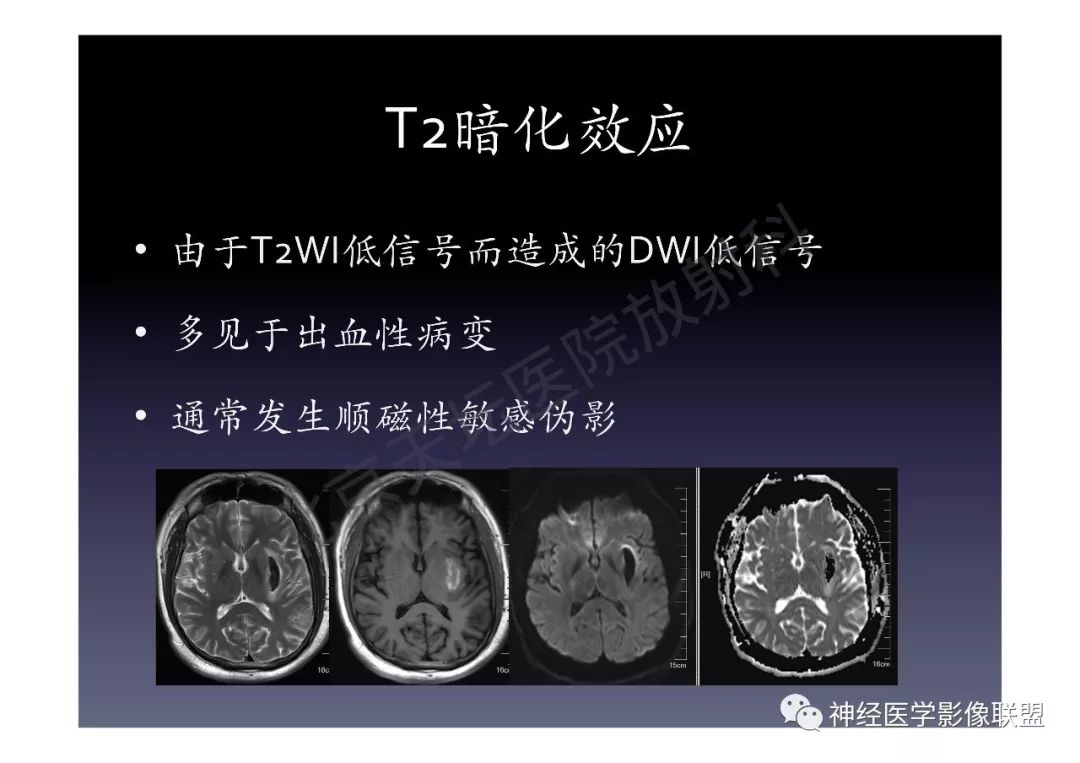 【PPT】颅内DWI高信号的MRI诊断