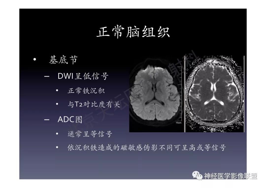【PPT】颅内DWI高信号的MRI诊断