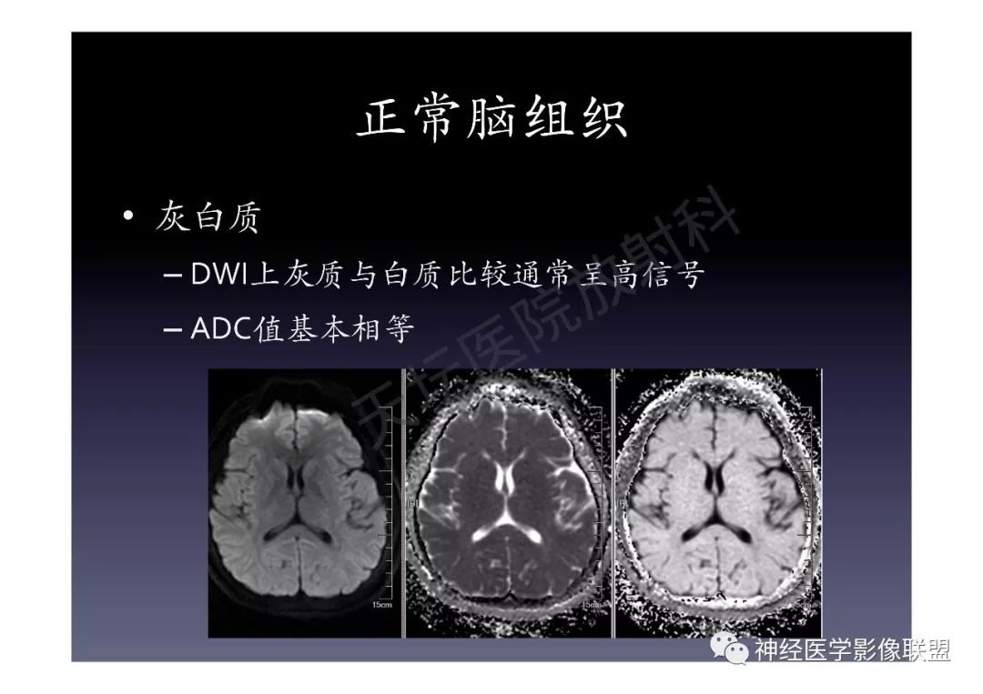 【PPT】颅内DWI高信号的MRI诊断