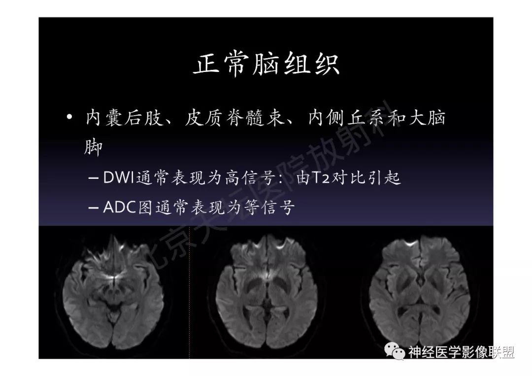 【PPT】颅内DWI高信号的MRI诊断
