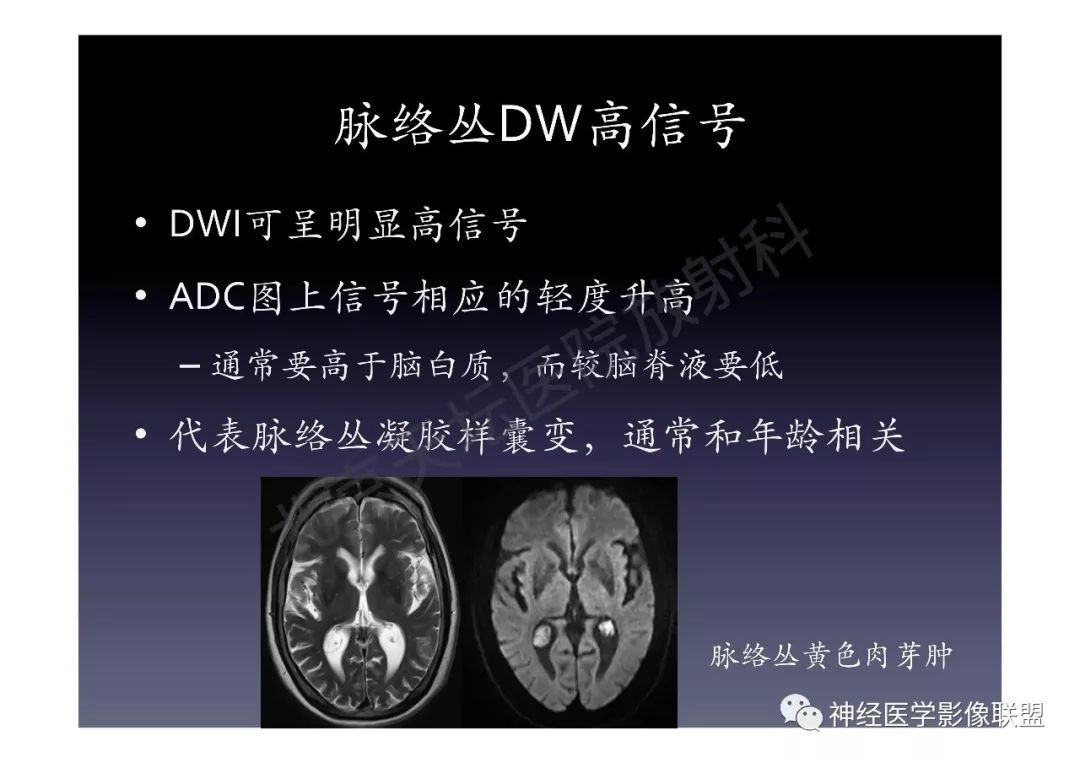 【PPT】颅内DWI高信号的MRI诊断