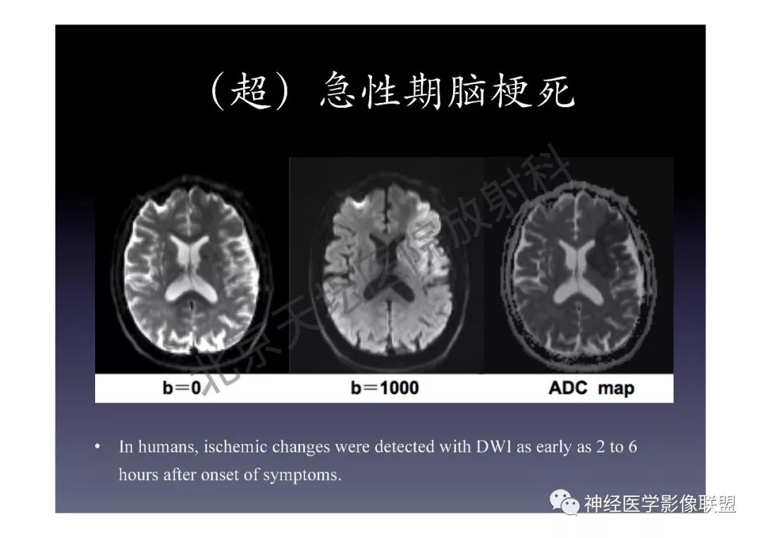 【PPT】颅内DWI高信号的MRI诊断