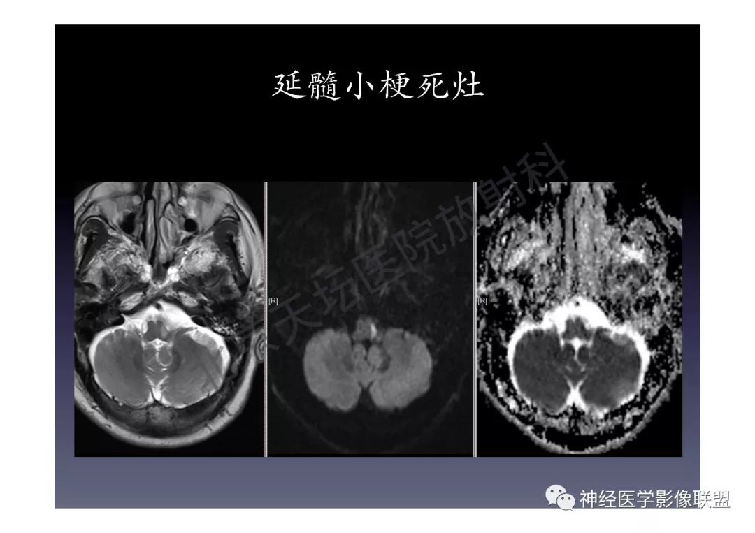 【PPT】颅内DWI高信号的MRI诊断