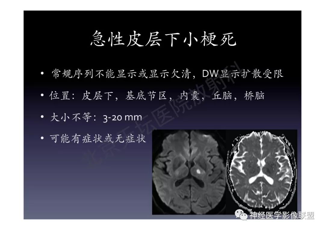 【PPT】颅内DWI高信号的MRI诊断