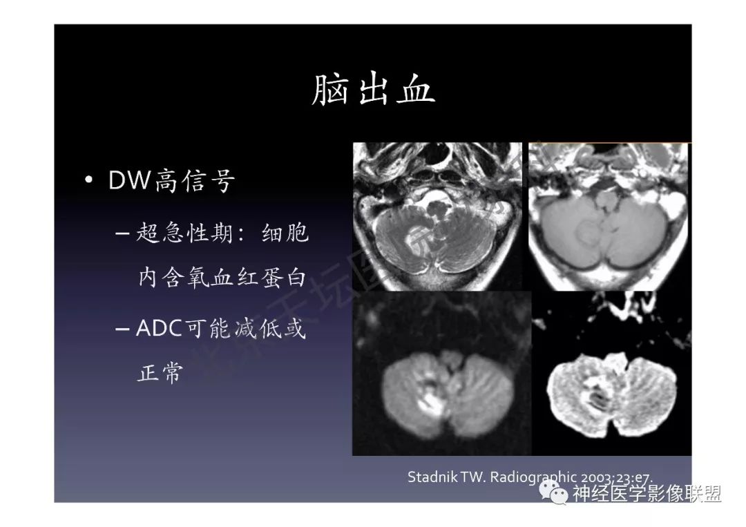 【PPT】颅内DWI高信号的MRI诊断