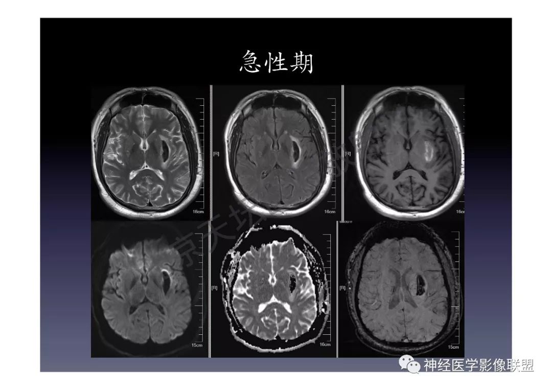 【PPT】颅内DWI高信号的MRI诊断