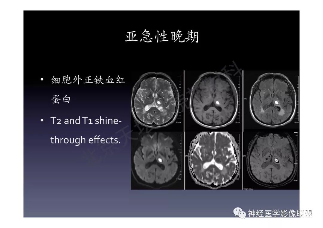 【PPT】颅内DWI高信号的MRI诊断