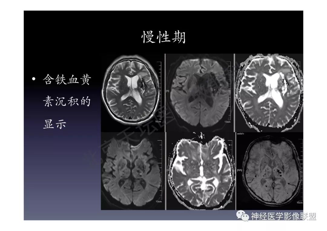 【PPT】颅内DWI高信号的MRI诊断