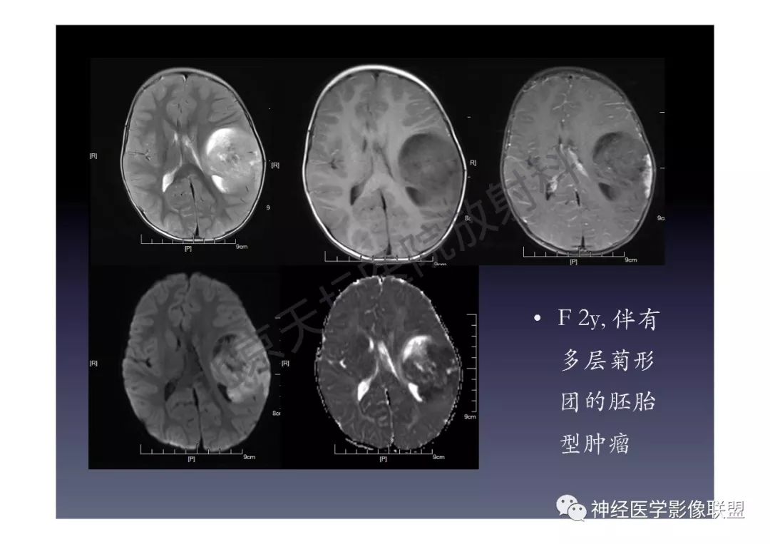【PPT】颅内DWI高信号的MRI诊断