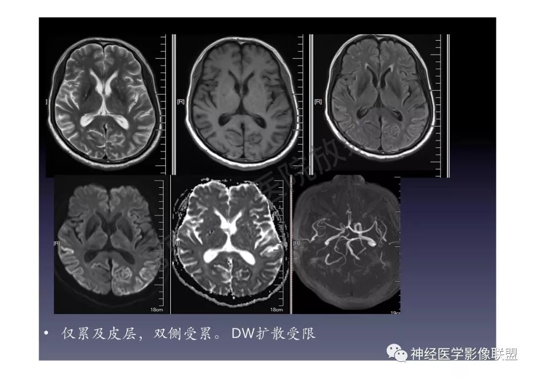 【PPT】颅内DWI高信号的MRI诊断