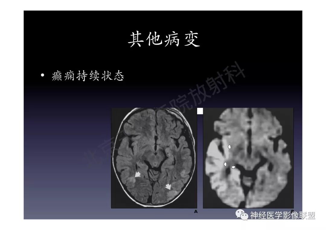 【PPT】颅内DWI高信号的MRI诊断
