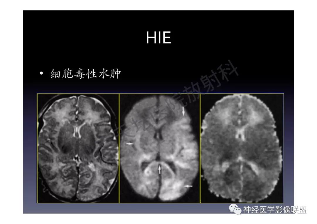 【PPT】颅内DWI高信号的MRI诊断
