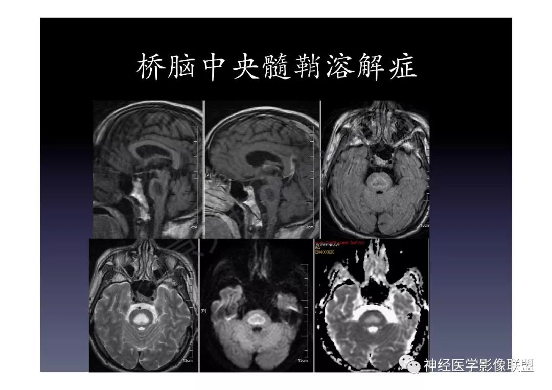 【PPT】颅内DWI高信号的MRI诊断