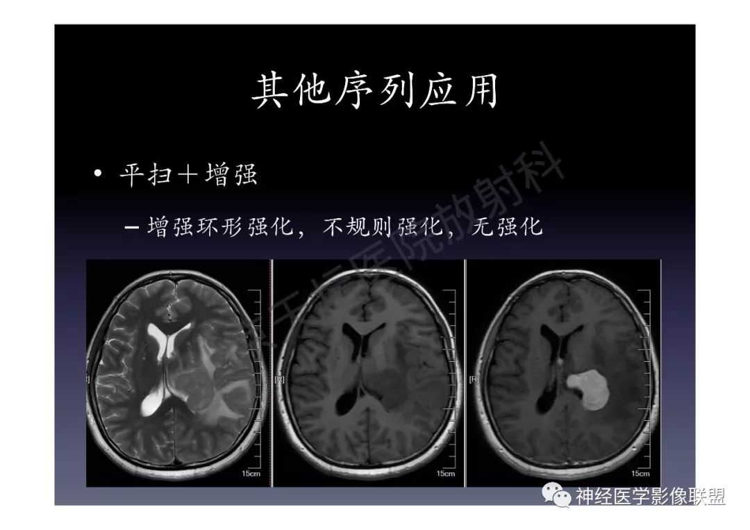 【PPT】颅内DWI高信号的MRI诊断