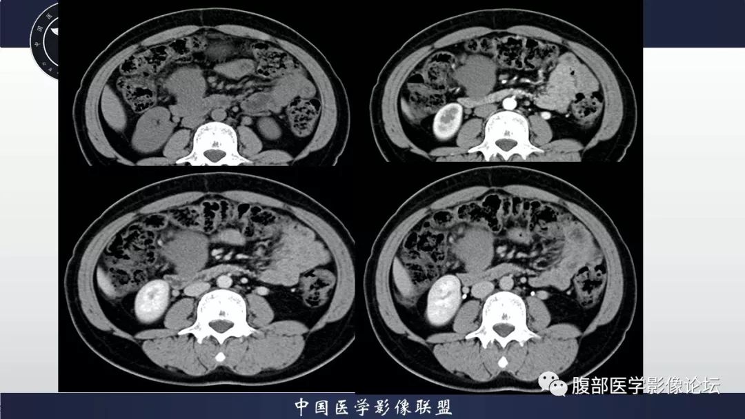 【病例】十二指肠水平部肠系膜纤维瘤病1例CT及MR