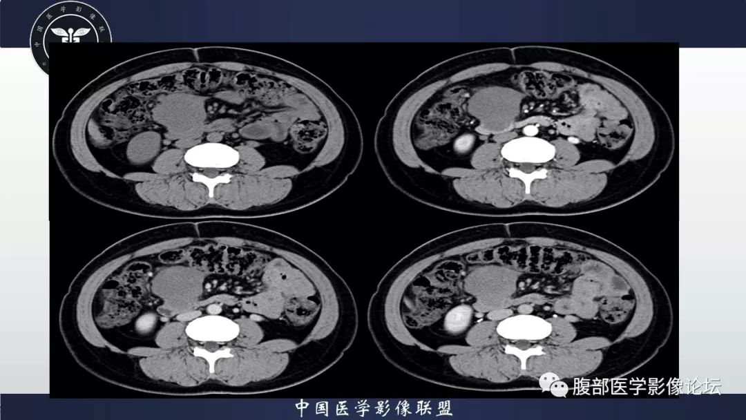 【病例】十二指肠水平部肠系膜纤维瘤病1例CT及MR