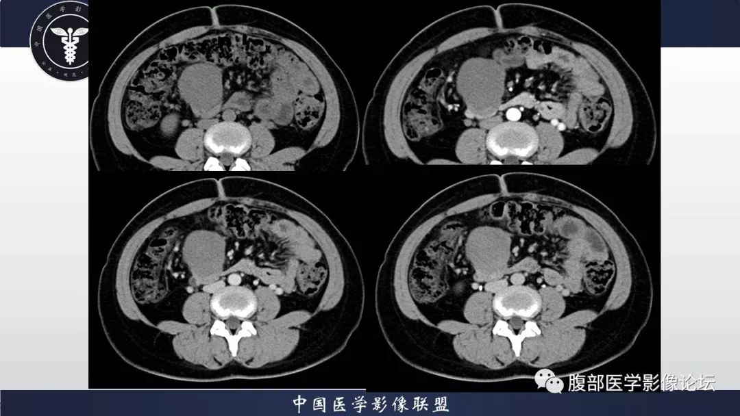 【病例】十二指肠水平部肠系膜纤维瘤病1例CT及MR