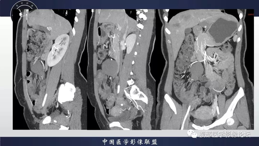 【病例】十二指肠水平部肠系膜纤维瘤病1例CT及MR
